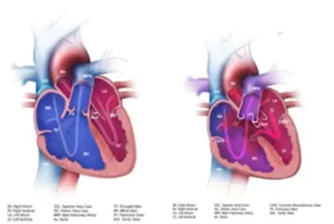 Atrio-Ventricular Septal Defect : 房室间隔缺损