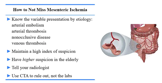 Non-Occlusive Mesenteric Infarction : 非闭塞性肠系膜梗死