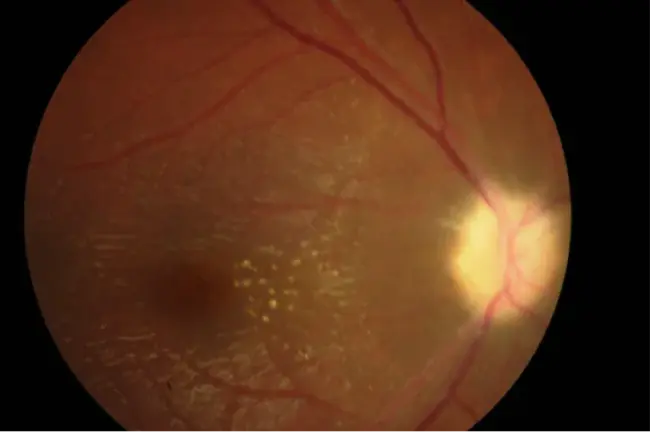 Non-arteritic Anterior Ischemic Optic Neuropathy : 非动脉性前缺血性视神经病变