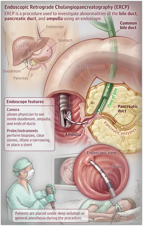 Endoscopic Retrograde Cholangio-Pancreatography : 内镜逆行胰胆管造影