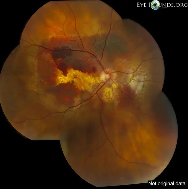 Polypoidal Choroidal Vasculopathy : 息肉状脉络膜血管病