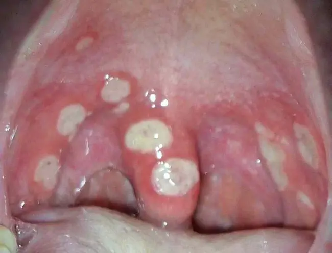 Viral Pharyngitis : 病毒性咽炎