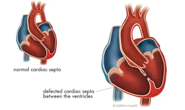 Inter-Atrial Septum : 房间隔