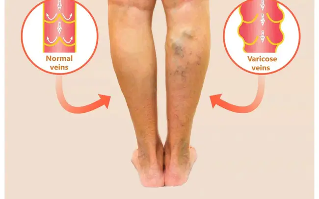 EndoVenous Laser Ablation : 腔内激光消融