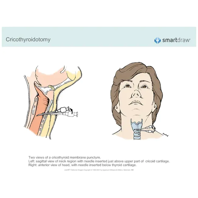 CRICothyroidotomy : 环甲切除术