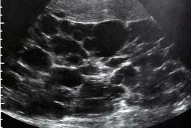 Autosomal Dominant-Retinal Vasculopathy with Cerebral Leukodystrophy : 常染色体显性视网膜血管病伴脑白质营养不良