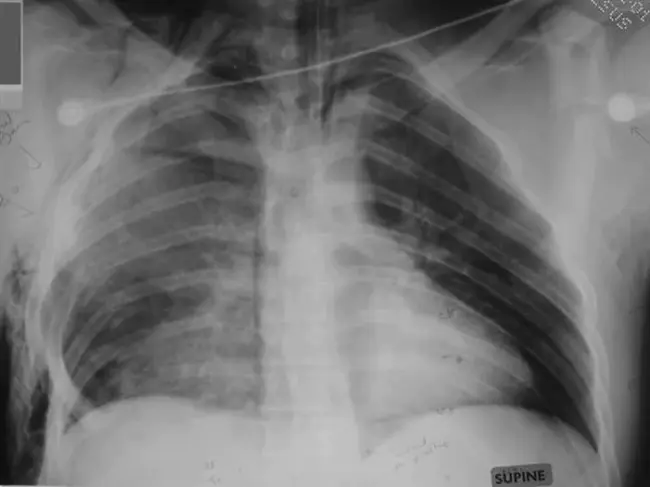 Chronic Allograft Nephropathy : 慢性同种异体肾病变