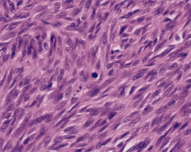 LeioMyoSarcoma : 平滑肌肉瘤