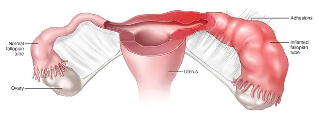 Tubo-Ovarian Abscess : 输卵管卵巢脓肿