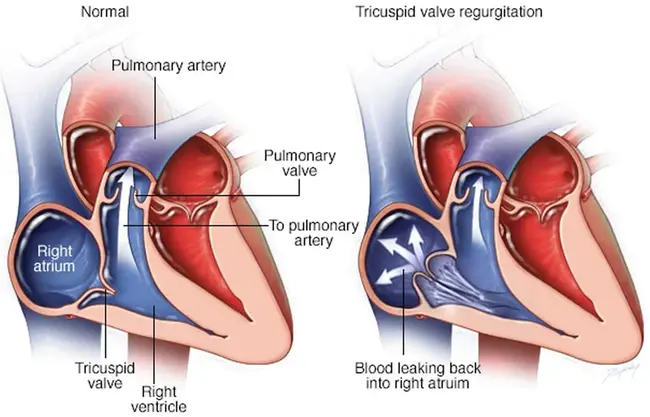 Tricuspid Regurgitant Jet Velocity : 三尖瓣返流射流速度