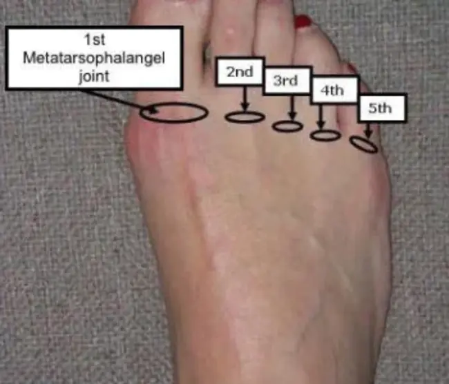 Metatarsophalangeal articulations : 跖指间关节