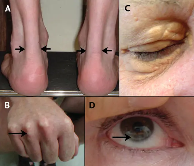 Familial Hypocalciuric Hypercalcemia : 家族性低钙血症