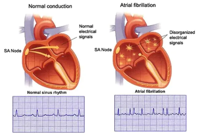 Left Heart Failure : 左心衰竭