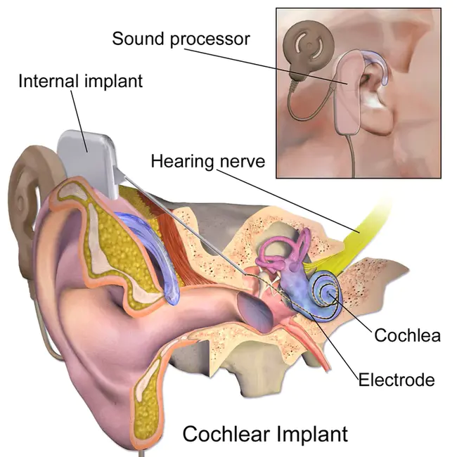 Cochlear Ltd : 科利耳有限公司