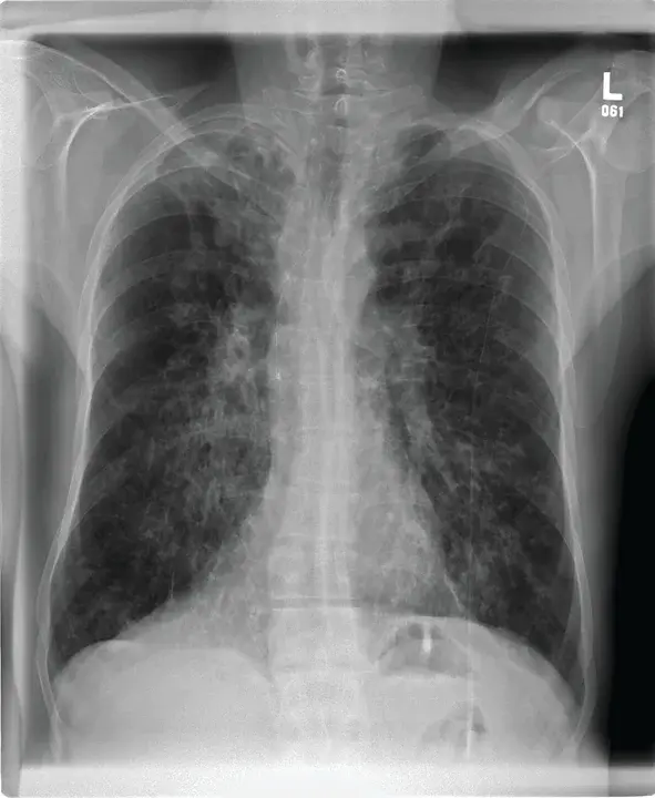 Cystic Fibrosis Transmembrane Conductance Regulator : 囊性纤维化跨膜电导调节器