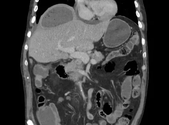 Brain Abscess : 脑脓肿