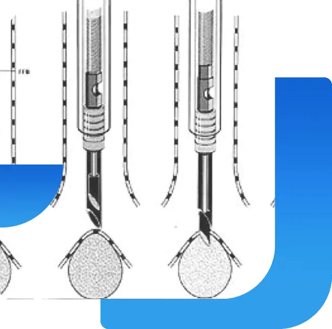 transbronchial needle aspiration : 经支气管针吸