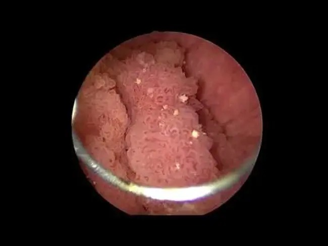 Transurethral Resection of Bladder Tumour : 经尿道膀胱肿瘤切除术