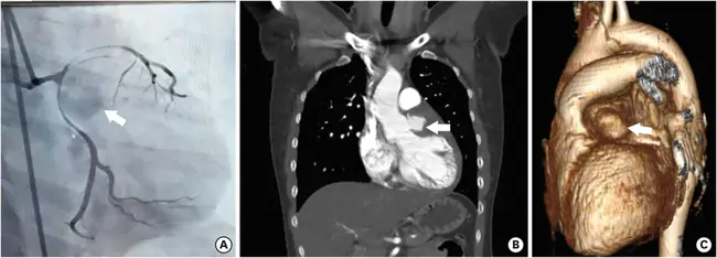 Coronary Computed Tomography Angiogram : 冠状动脉CT血管造影