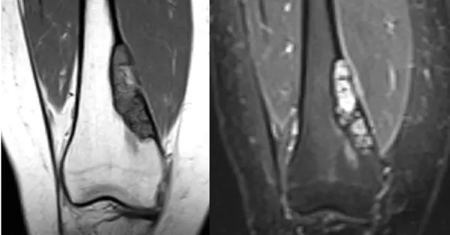 Non-Ossifying Fibroma : 非骨化性纤维瘤