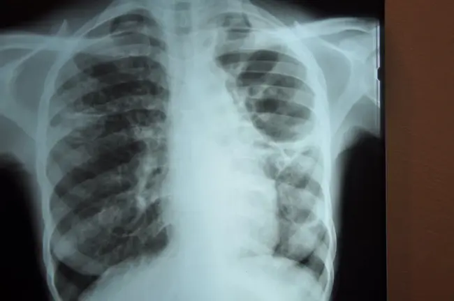 multidrug-resistant tuberculosis : 多药耐药结核