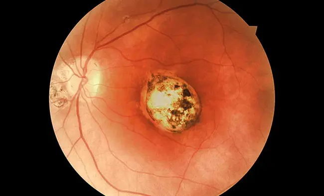 Congenital Toxoplasmosis : 先天性弓形虫病