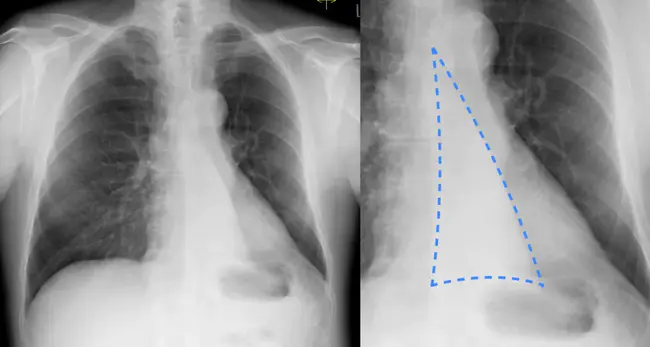 Left Lobe : 左叶