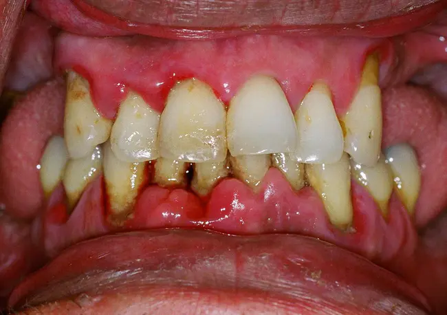Periodontal Disease : 牙周病