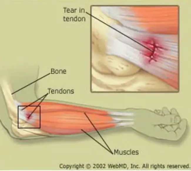 Tendon jerk(s) : 肌腱挺举