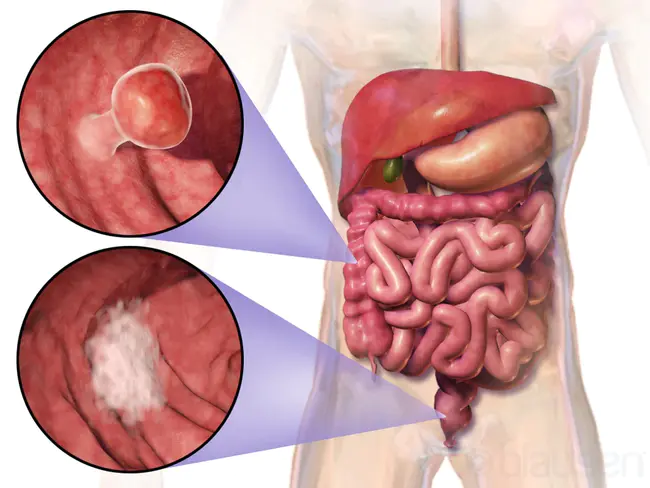 Colorectal Cancer Control Program : 结直肠癌控制计划