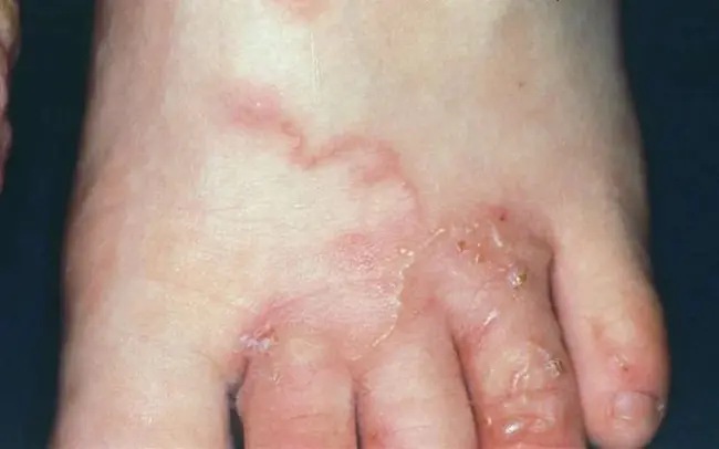 Cutaneous Larva Migrans : 皮肤幼虫迁移