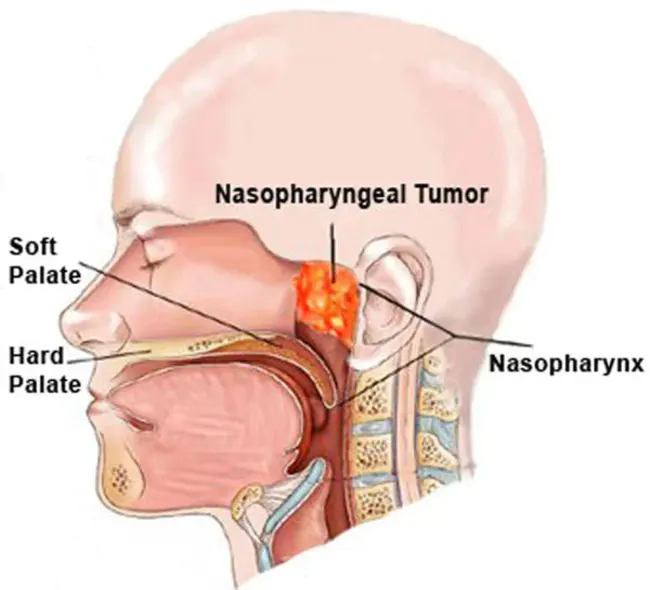 Nasopharynx Swab : 鼻咽拭子