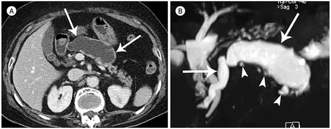 Intraductal Papillary Mucinous Tumor : 导管内乳头状粘液性肿瘤