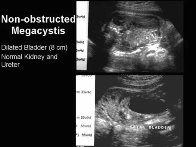 Megacystis-Microcolon-Intestinal Hypoperistalsis Syndrome : 巨胱氨酸微粒体肠蠕动不足综合征