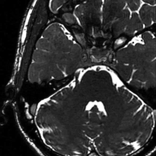 Painful Traumatic Trigeminal Neuropathy : 疼痛性创伤性三叉神经病变