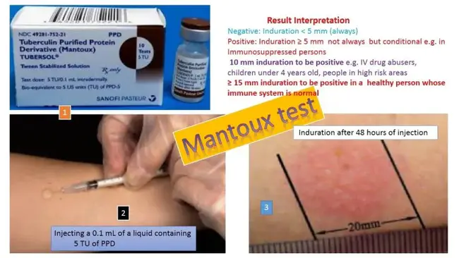 tuberculin test(ed) : 结核菌素试验