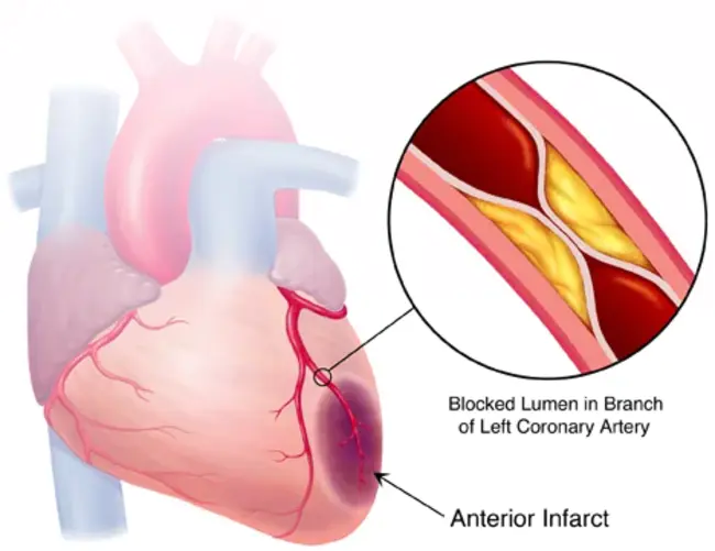 myocardial infarct(ion) : 心肌梗死