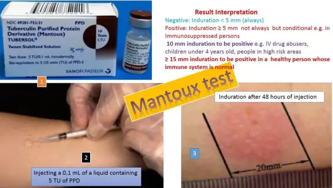 Mantoux Test : 曼图克斯试验
