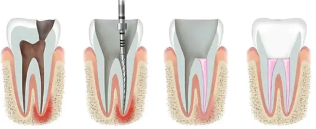 Root Canal : 牙根管