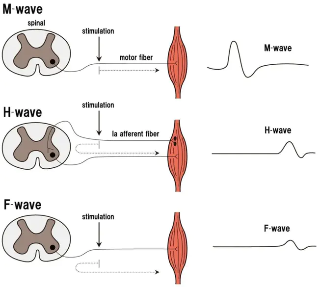 F-wave minimal latency : F波最小延迟