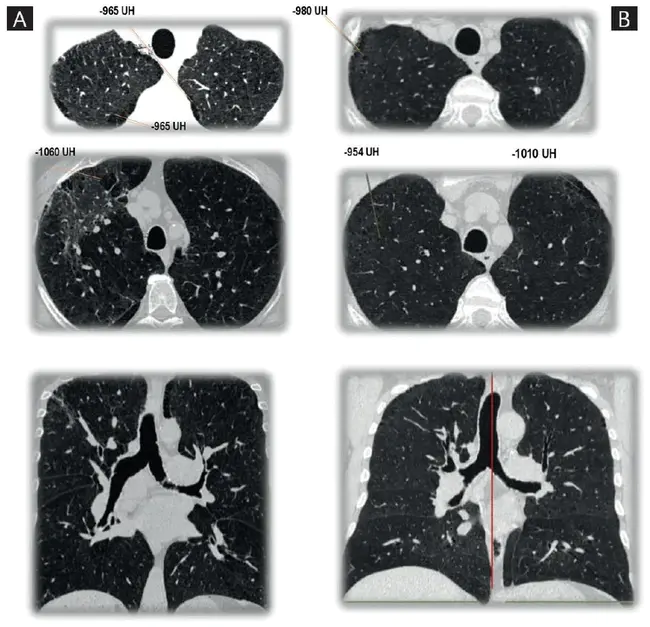 Pulmonary veno-occlusive disease : 肺静脉闭塞性疾病