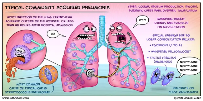 Community-acquired pneumonia : 社区获得性肺炎