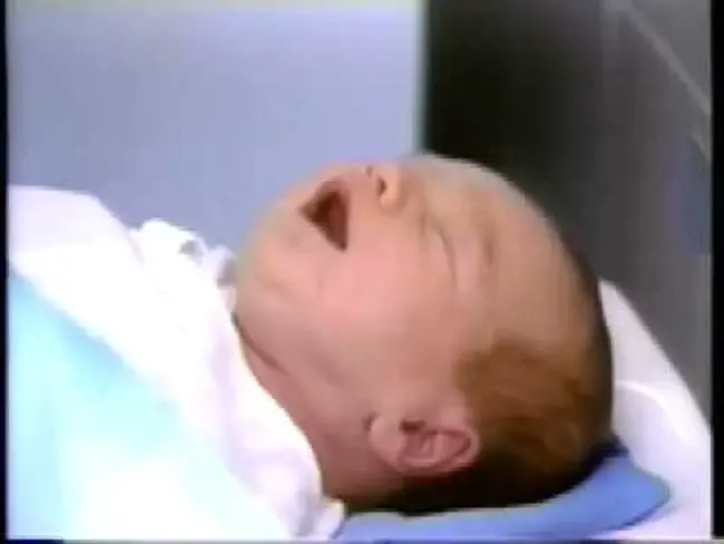 Infant Male Circumcision : 婴儿包皮环切术