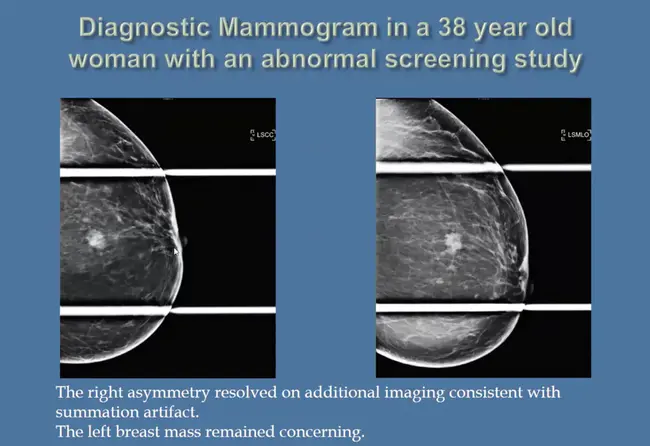 Breast and Cervical Cancer Program : 乳腺癌和宫颈癌项目