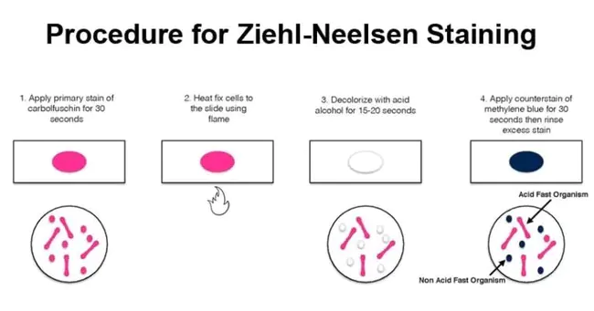 Ziehl-Neelsen : 齐尔-尼尔森