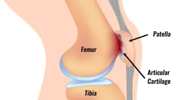 patellofemoral pain syndrome : 髌股疼痛综合征