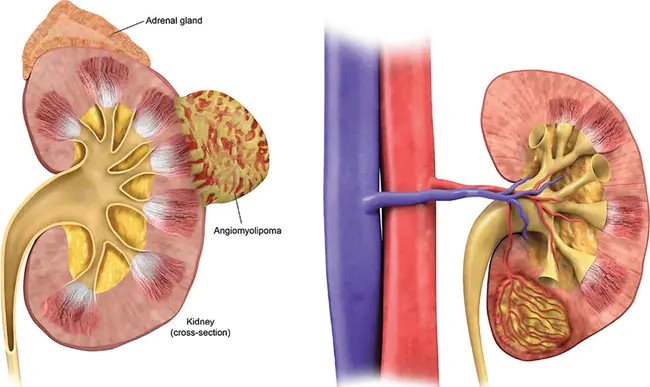 angiomyolipoma(s) : 血管肌脂肪瘤