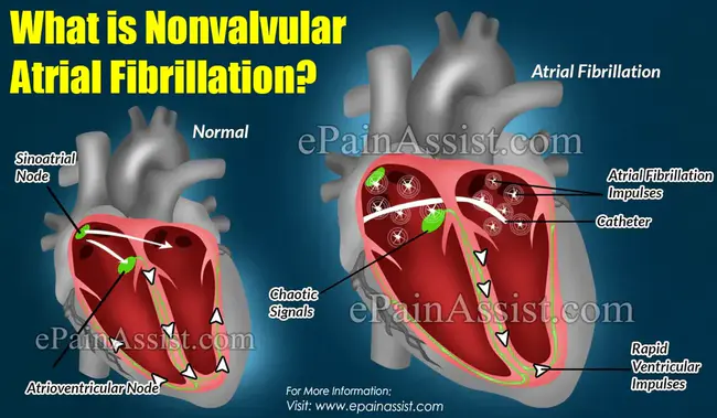 Non-Valvular Atrial Fibrillation : 非瓣膜性房颤