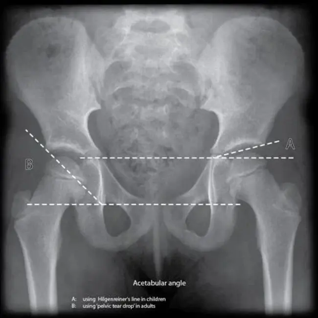 Acetabular Index : 髋臼指数