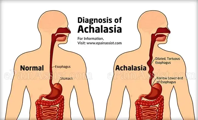 achalasia : 贲门失弛缓症